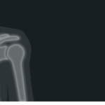 An X-ray of a shoulder.