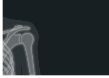 An X-ray of a shoulder.