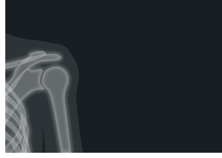 An X-ray of a shoulder.